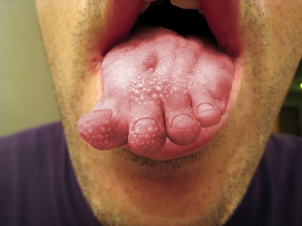 Creation of Do I Have Athlete's Tongue?: Step 3